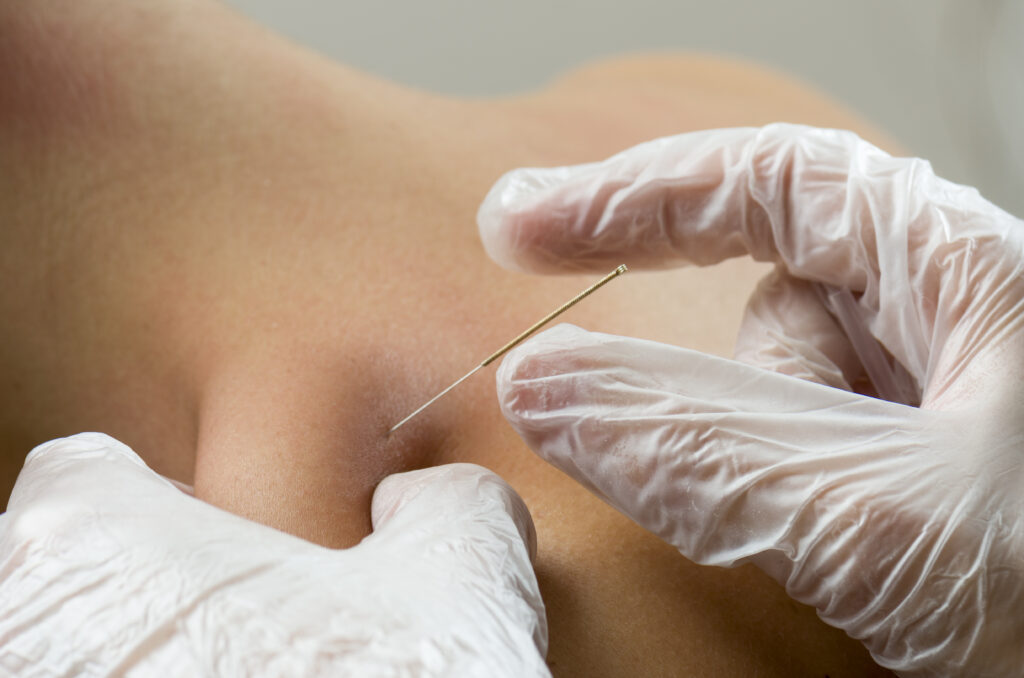 Fysiotherapie: Dry Needling